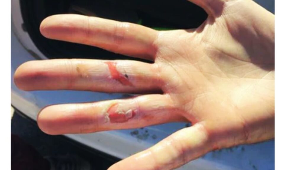 Rope Burns Are More Serious Than They Look