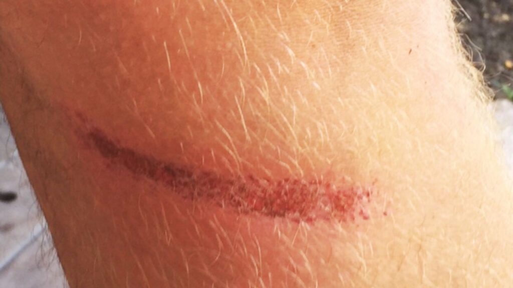 What Is a Rope Burn?